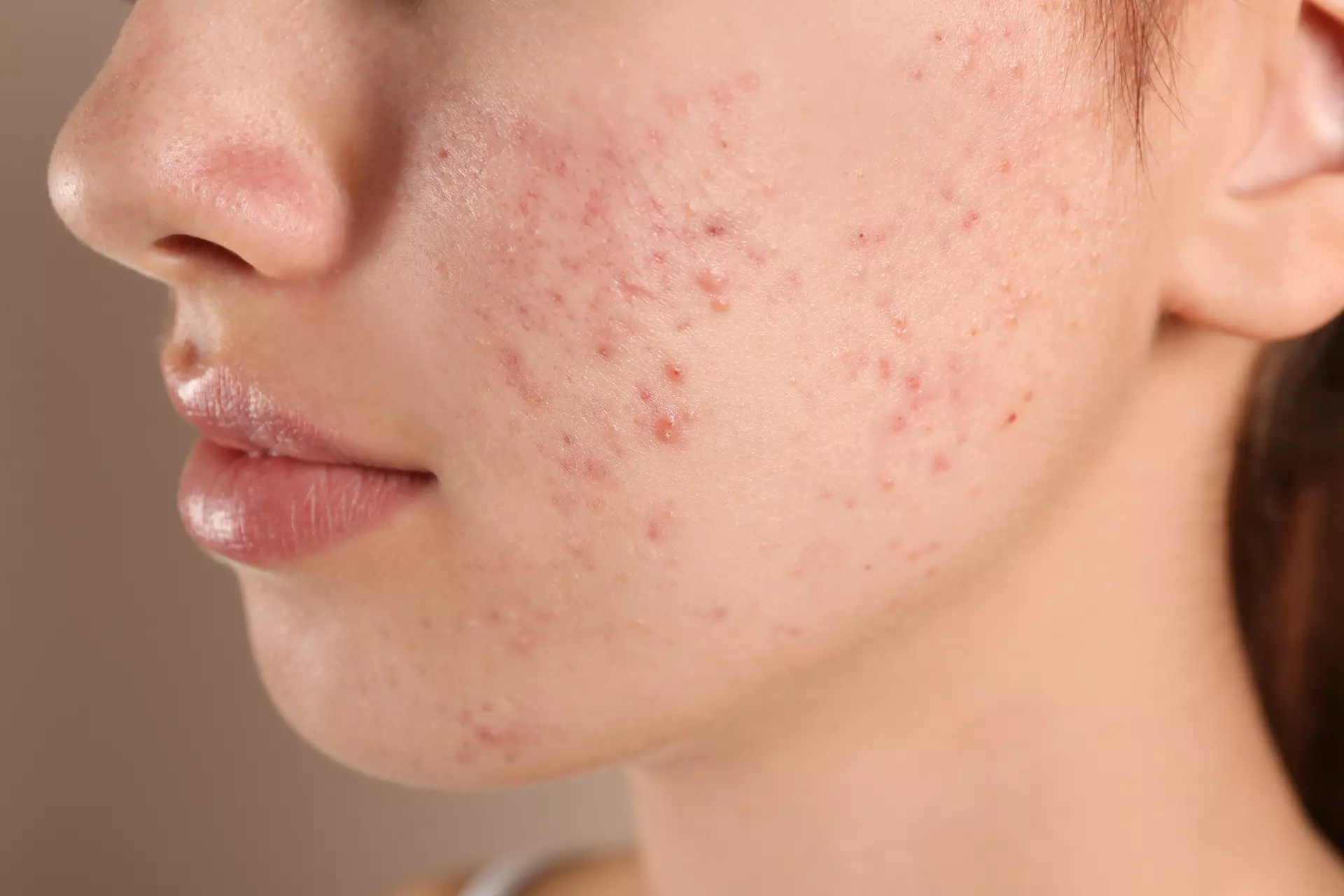 Acne Salt Lake City, UT